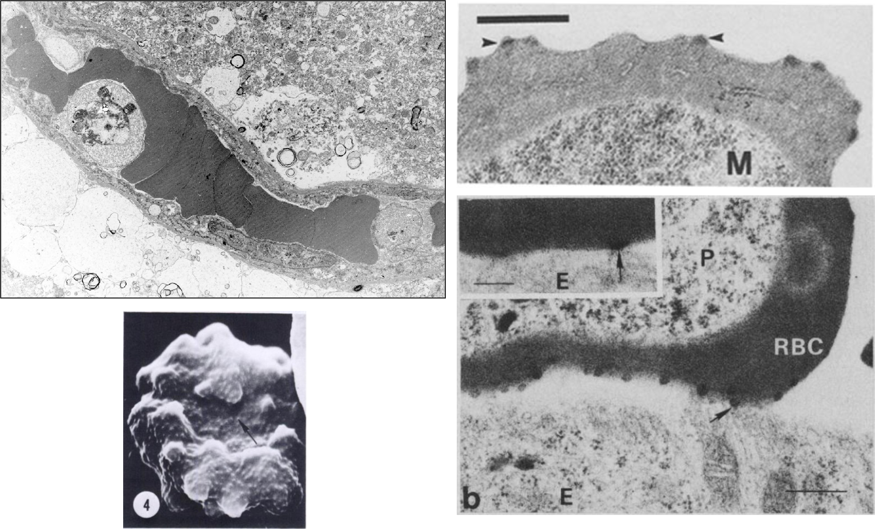 As malaria parasites remodel their host red blood cell, they create knobs that appear on the surface of the parasitized RBC. These knobs contain proteins that adhere to proteins expressed on the interior surfaces of capillaries in specific organs, such as the brain, lungs, or intestines.